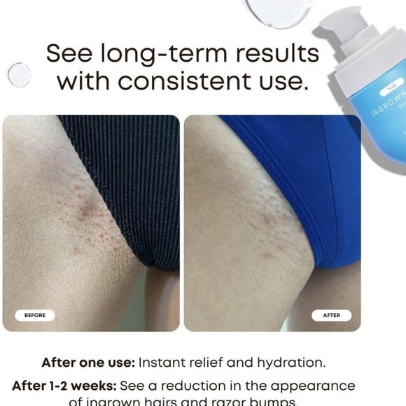 NEW Bushbalm Ingrown Hair Oil | 30ml - Picture 2 of 3